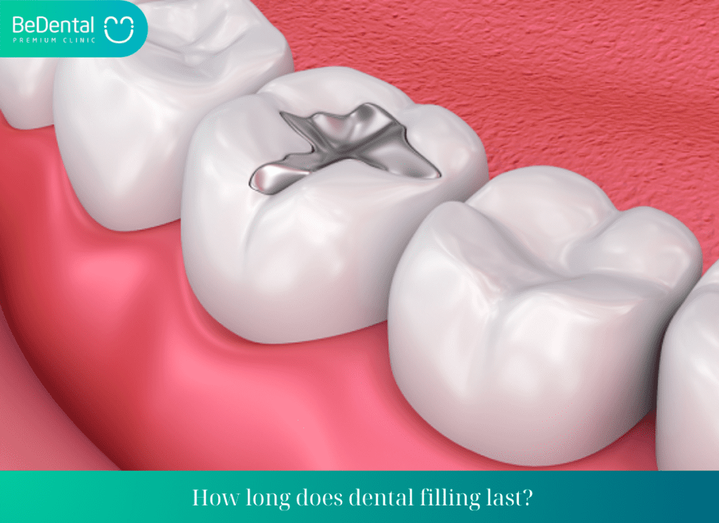 How long does dental filling last