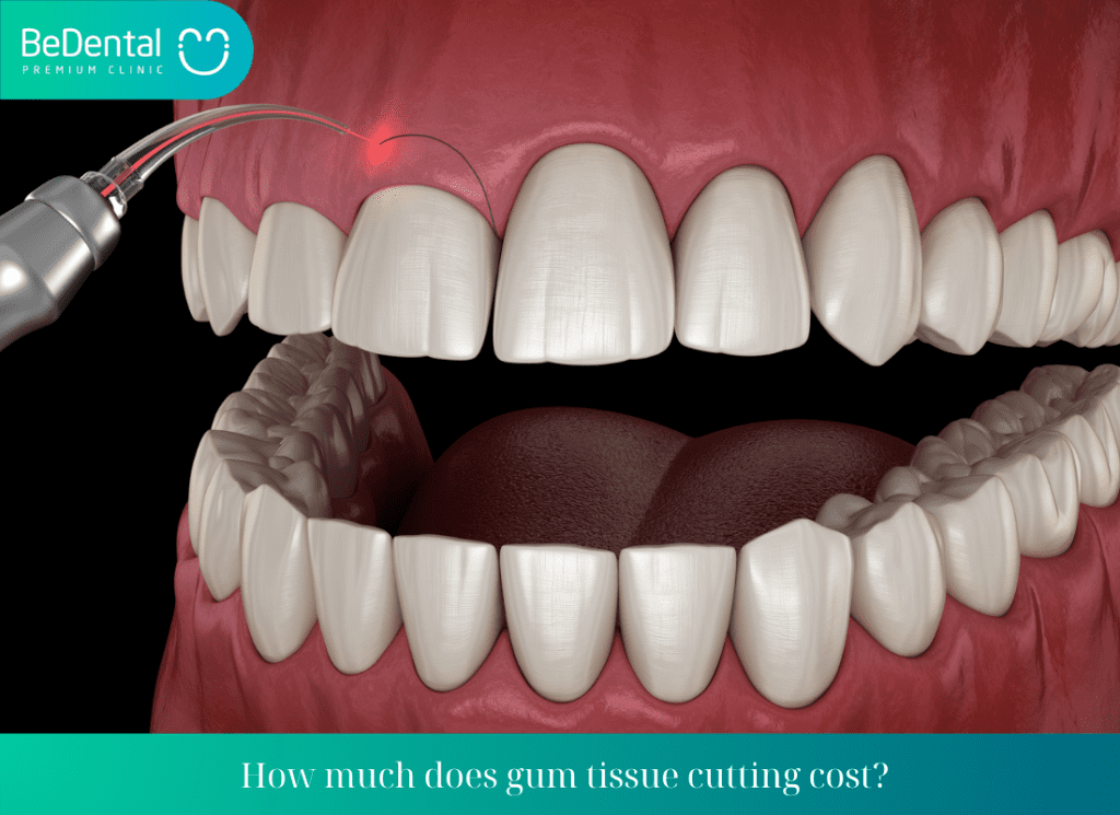 How much does gum tissue cutting cost