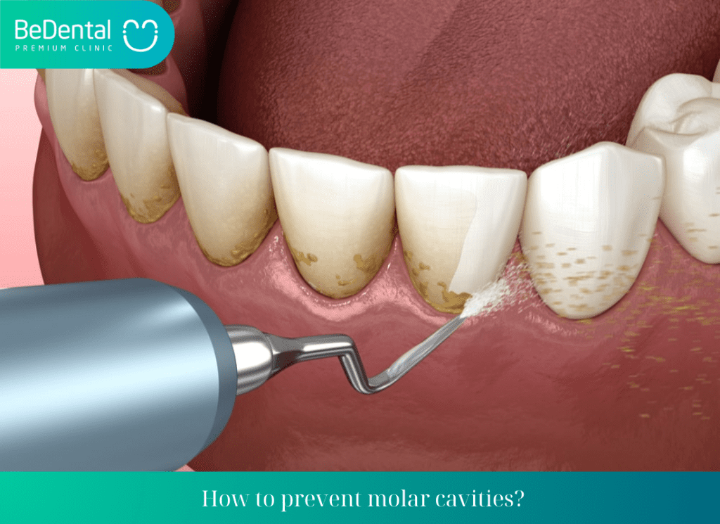 How to prevent molar cavities