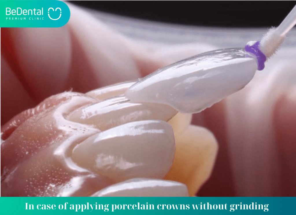 In case of applying porcelain crowns without grinding