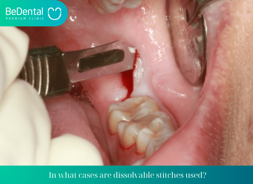 In what cases are dissolvable stitches used