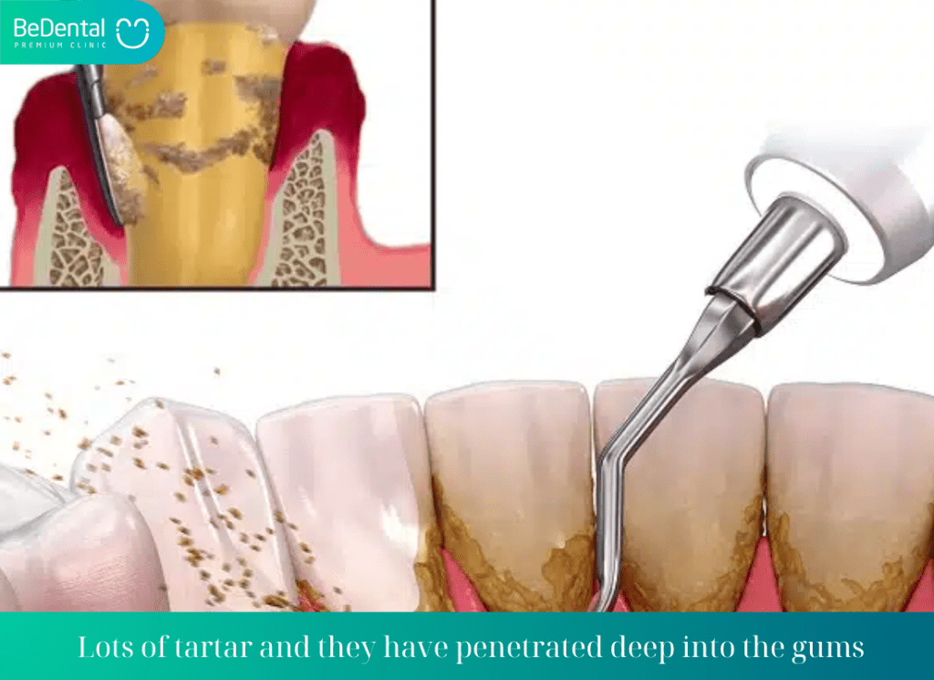 Lots of tartar and they have penetrated deep into the gums