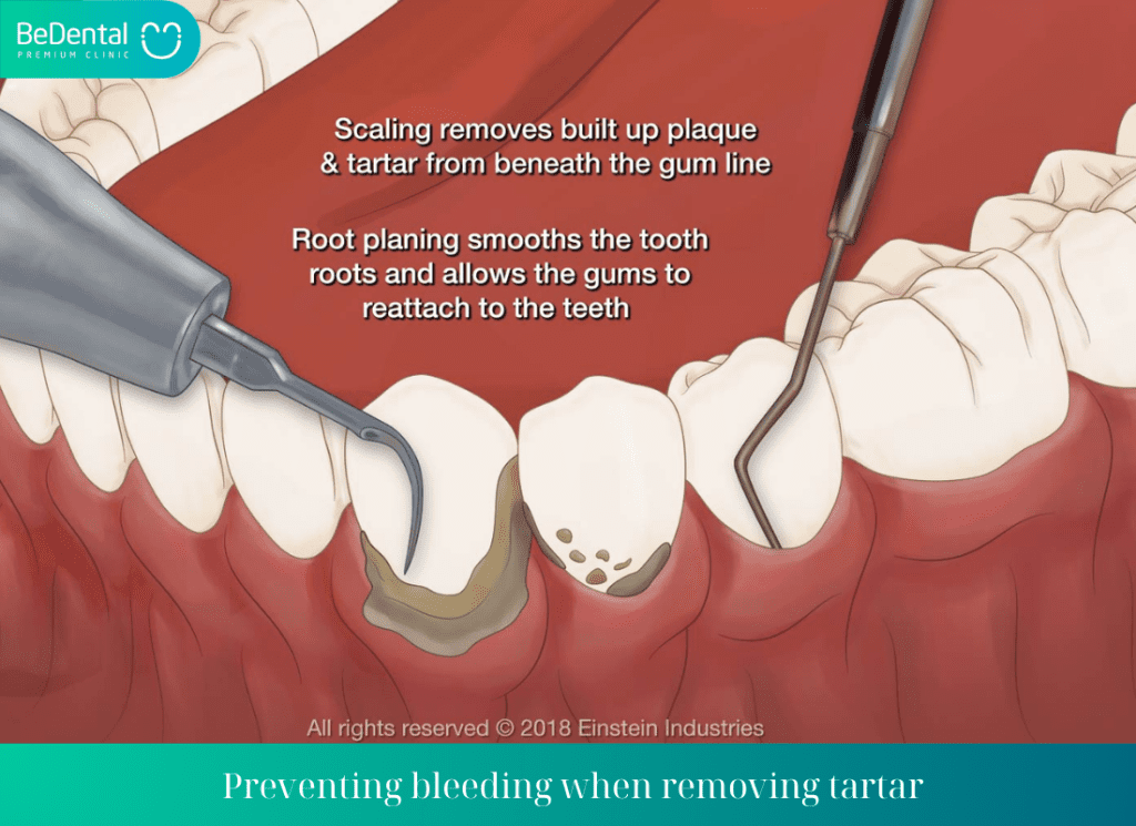 Preventing bleeding when removing tartar