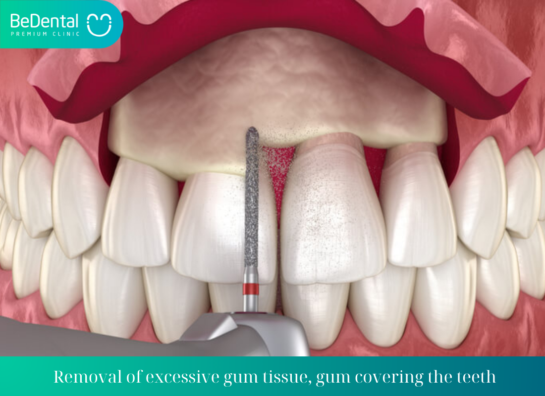 Removal of excessive gum tissue gum covering the teeth