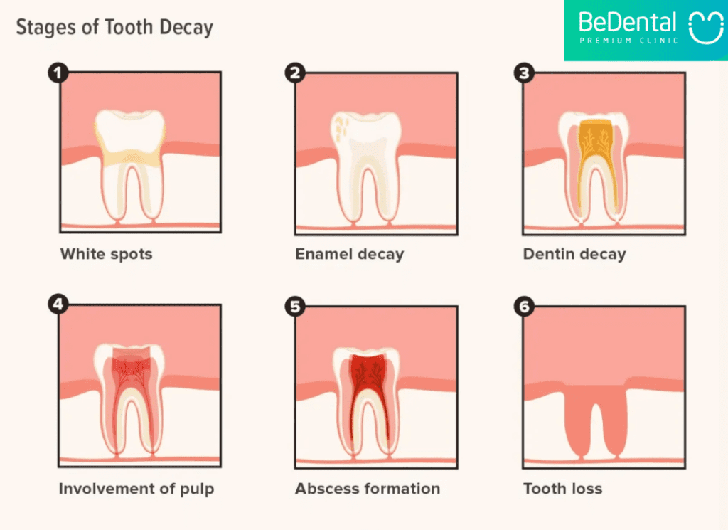 Stages of tooth decay