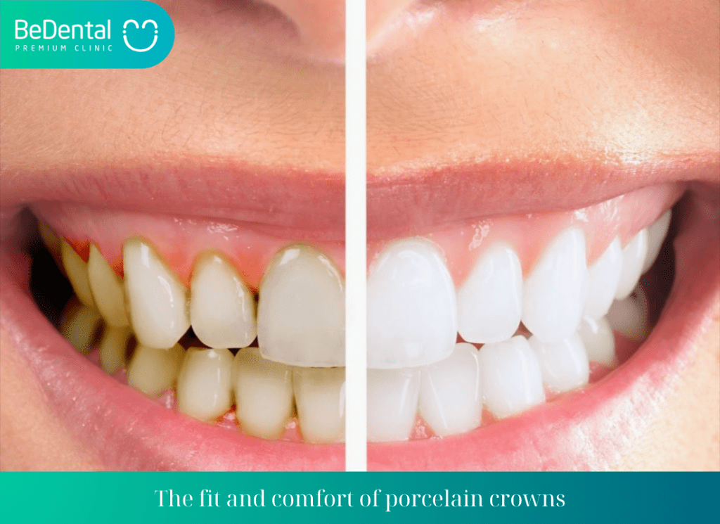 The fit and comfort of porcelain crowns