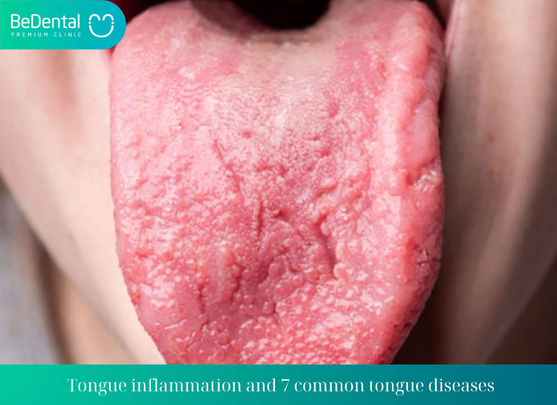 Tongue inflammation and 7 common tongue diseases