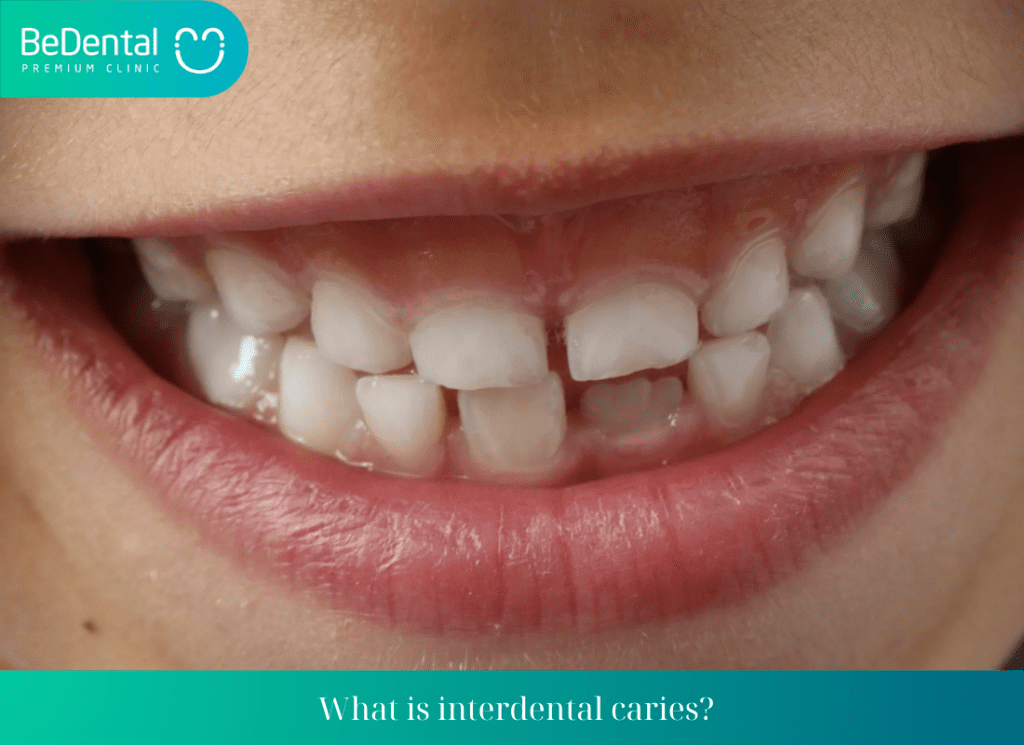 What is interdental caries?