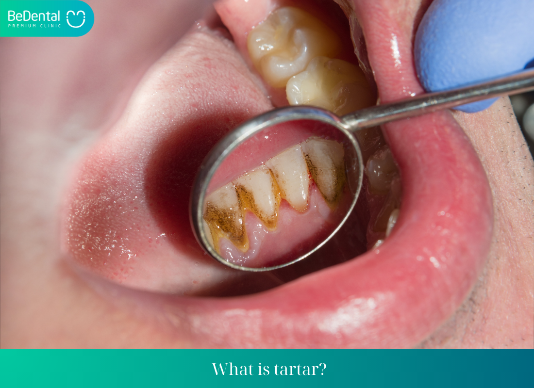 What is tartar? Is tooth scaling painful? Benefits of scaling teeth