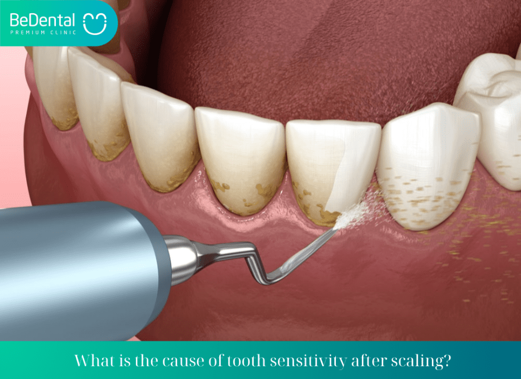 What is the cause of teeth sensitivity after scaling