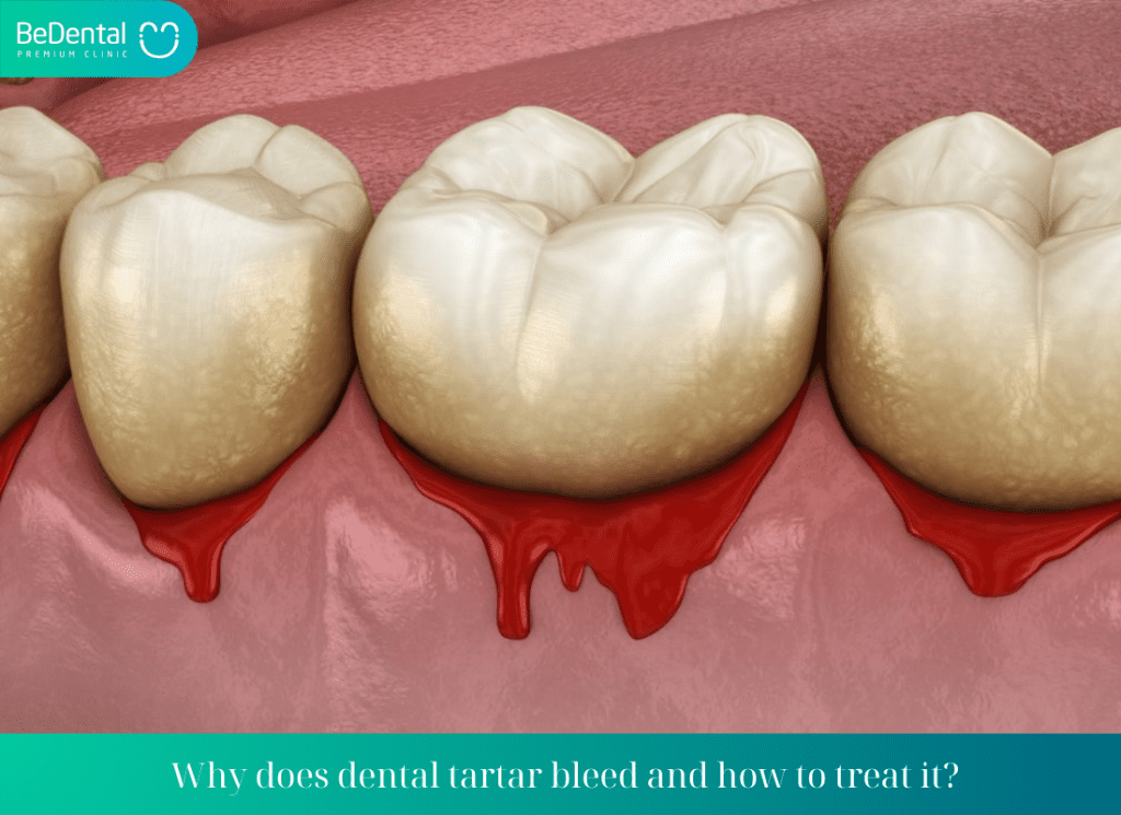 Why does dental tartar bleed and how to treat it