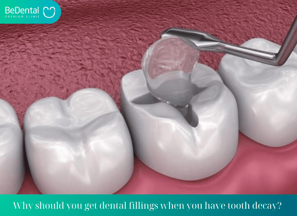 Why should you get dental fillings when you have tooth decay