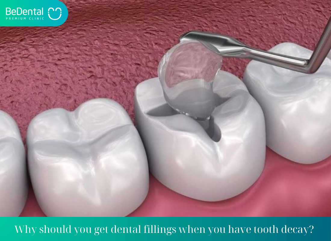 Why should you get dental fillings when you have tooth decay