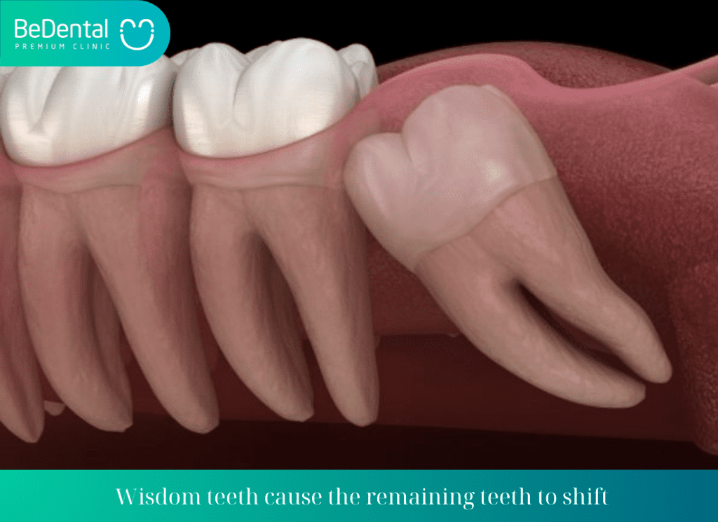 Wisdom teeth cause the remaining teeth to shift