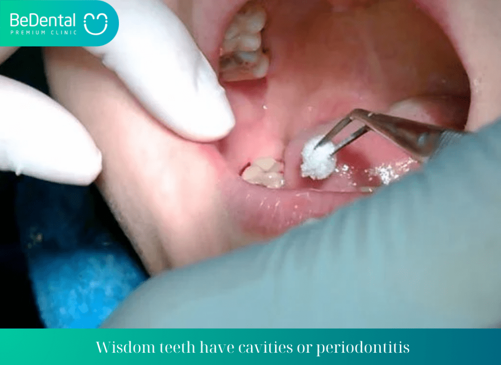 Wisdom teeth have cavities or periodontitis