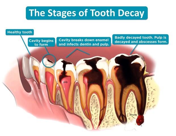 What is a tooth cavity? Which bacteria causes tooth cavity? How to protect teeth from cavities