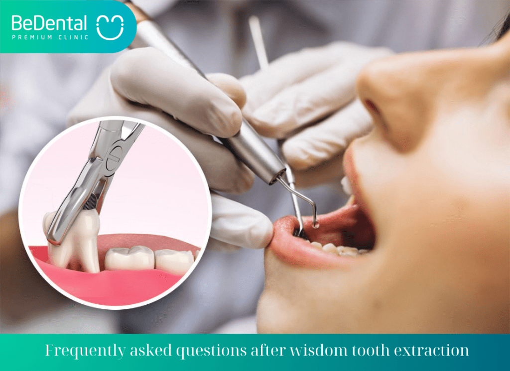 frequently asked questions after wisdom tooth extraction