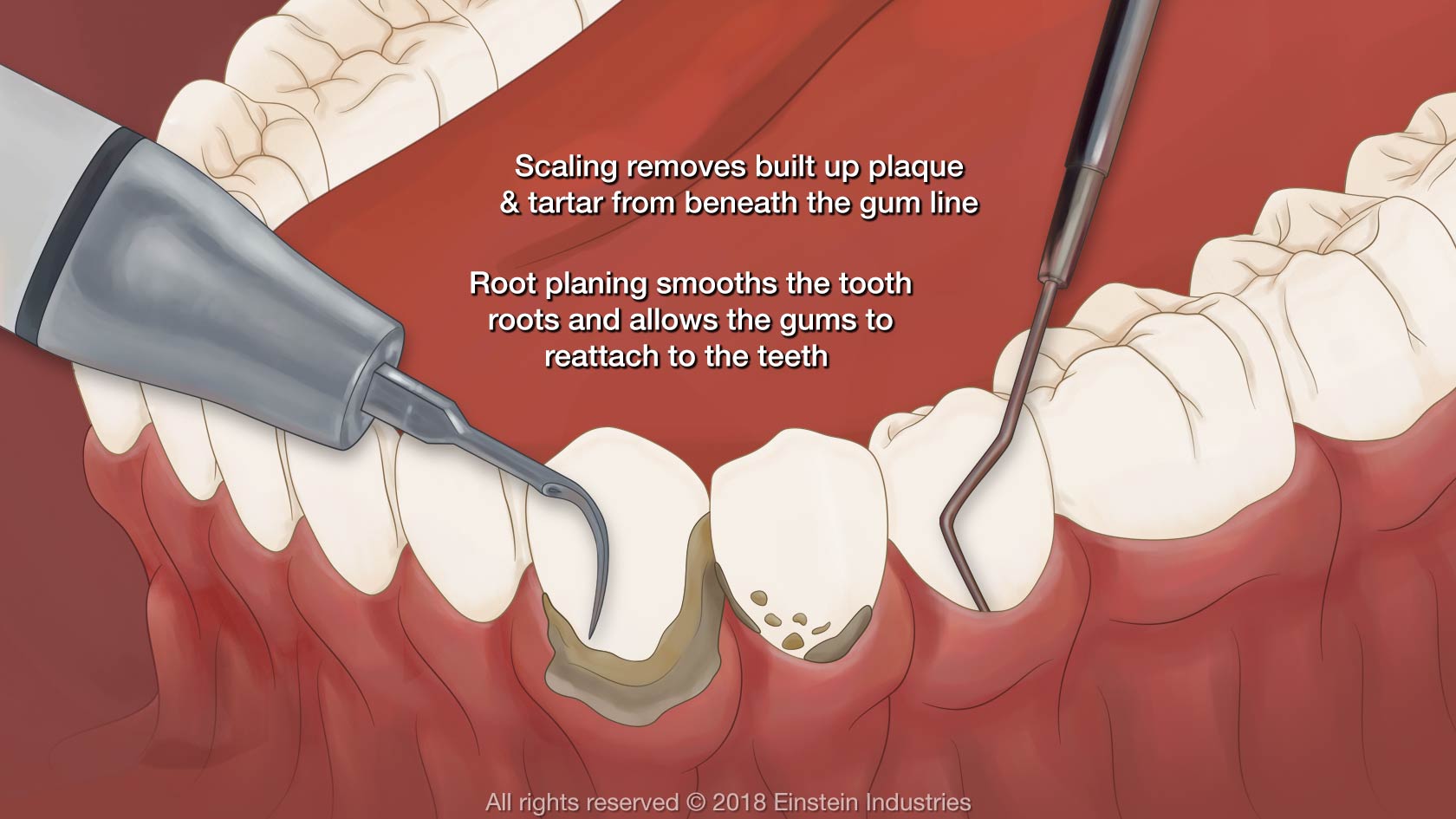 What is the cause of tooth sensitivity after scaling?