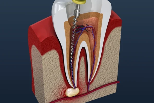 root canal treatment 078475 edited 1