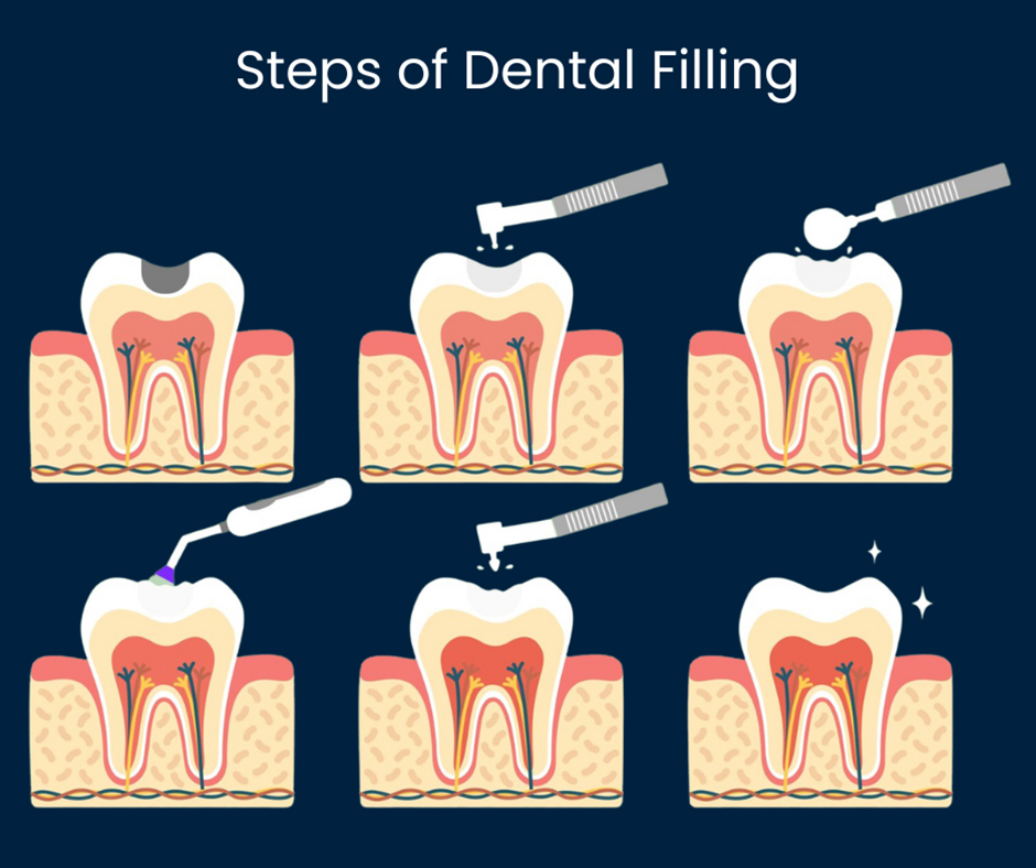 In what cases should tooth filling be performed?