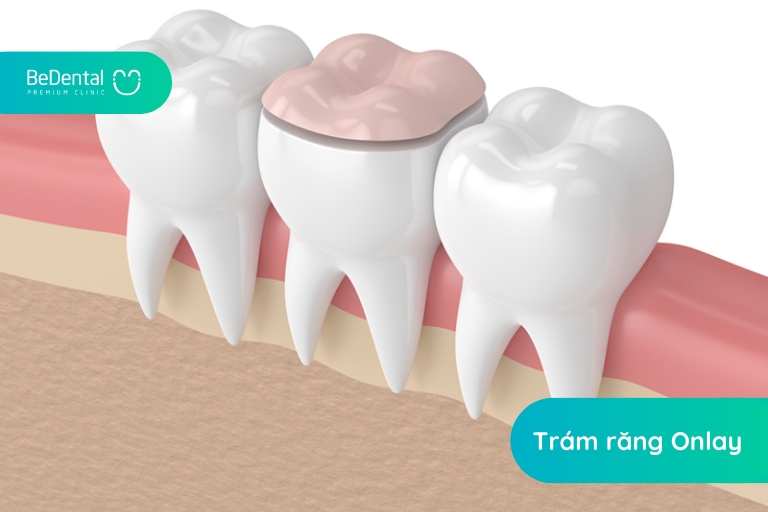 tram rang inlay onlay 3