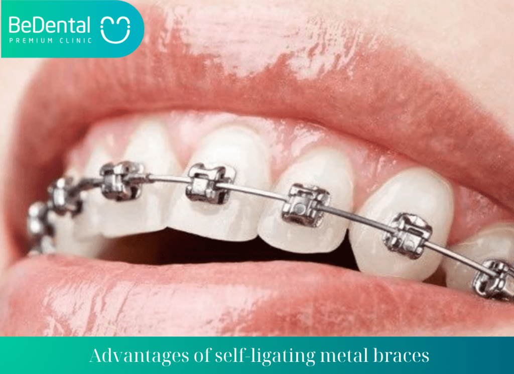 Advantages of self ligating metal braces