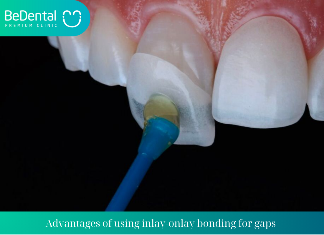 Advantages of using inlay onlay bonding for gaps