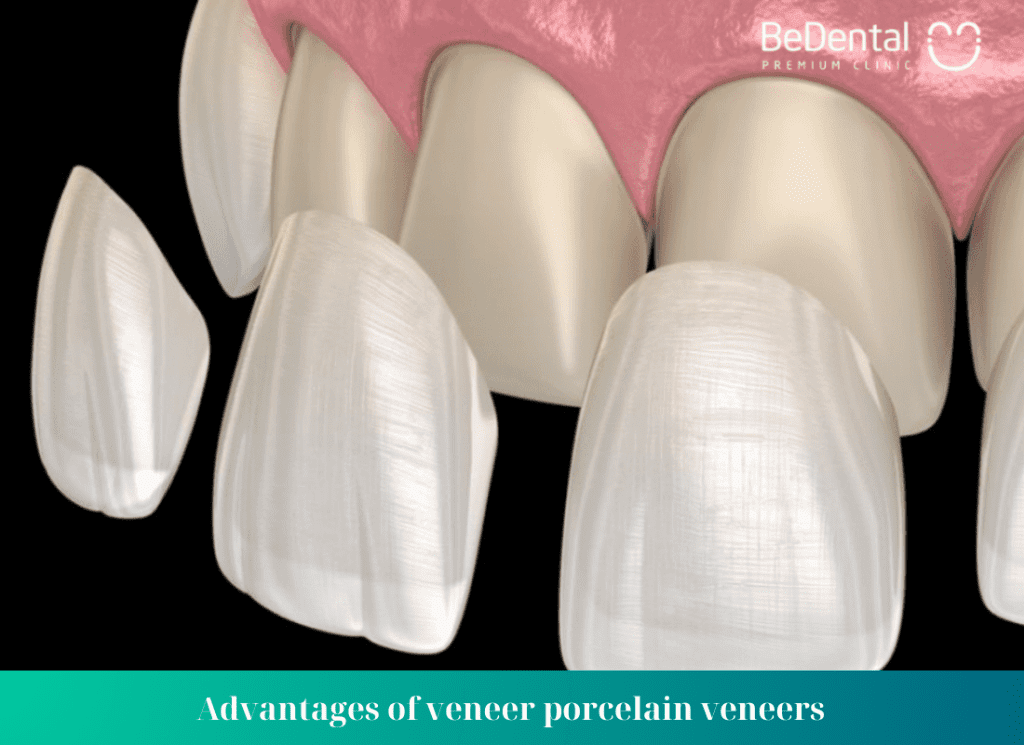 Which types of porcelain veneers are used