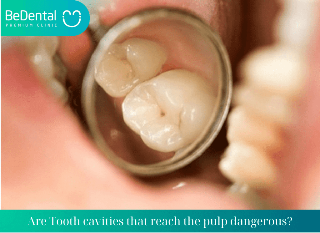 Are Tooth cavities that reach the pulp dangerous