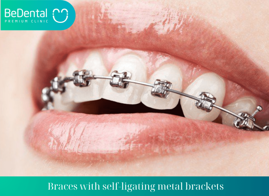 Braces with self ligating metal brackets