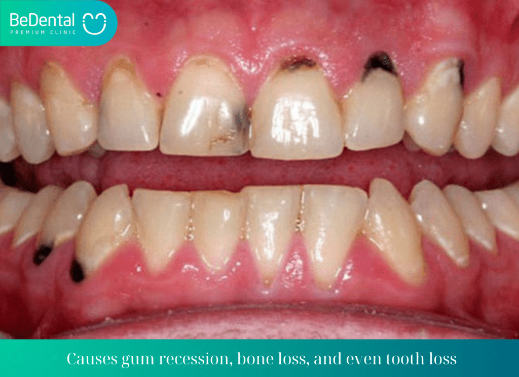 Causes gum recession bone loss and even tooth loss