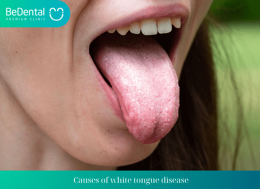 Causes of white tongue disease