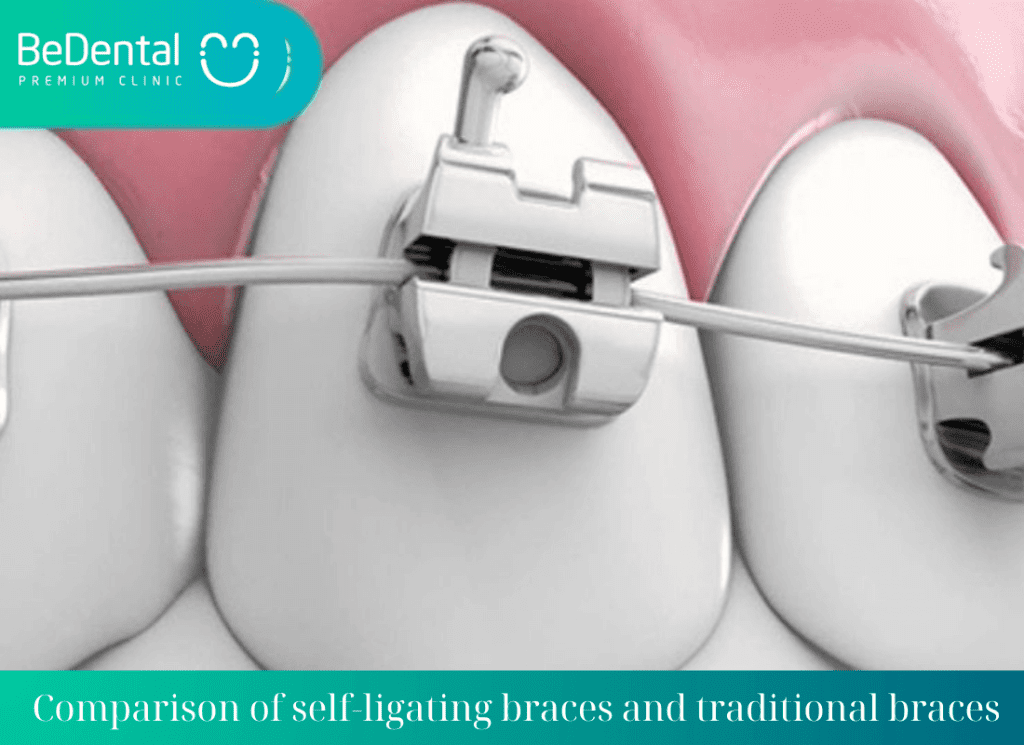 Braces with self-ligating metal brackets