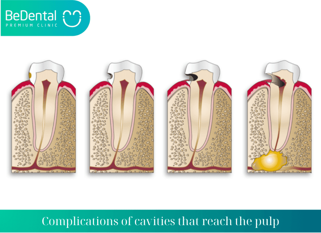 Complications of cavities that reach the pulp