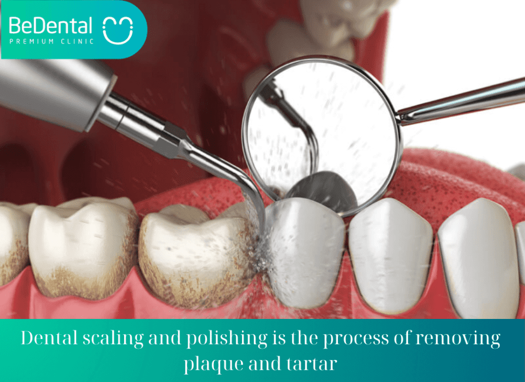 Dental scaling and polishing is the process of removing plaque and tartar