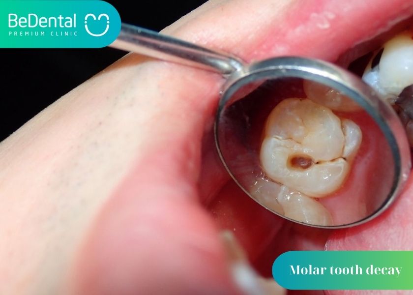 Can molars be extracted? Why is molar tooth decay so common? Methods of treating decayed molars.