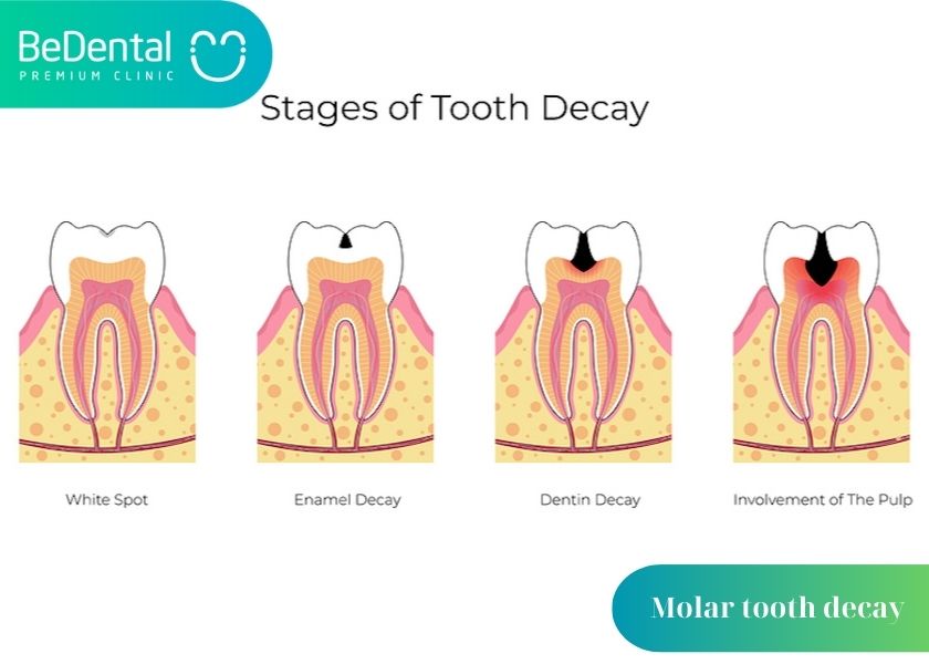 Can molars be extracted? Why is molar tooth decay so common? Methods of treating decayed molars.