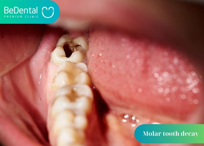 Can molars be extracted? Why is molar tooth decay so common? Methods of treating decayed molars.