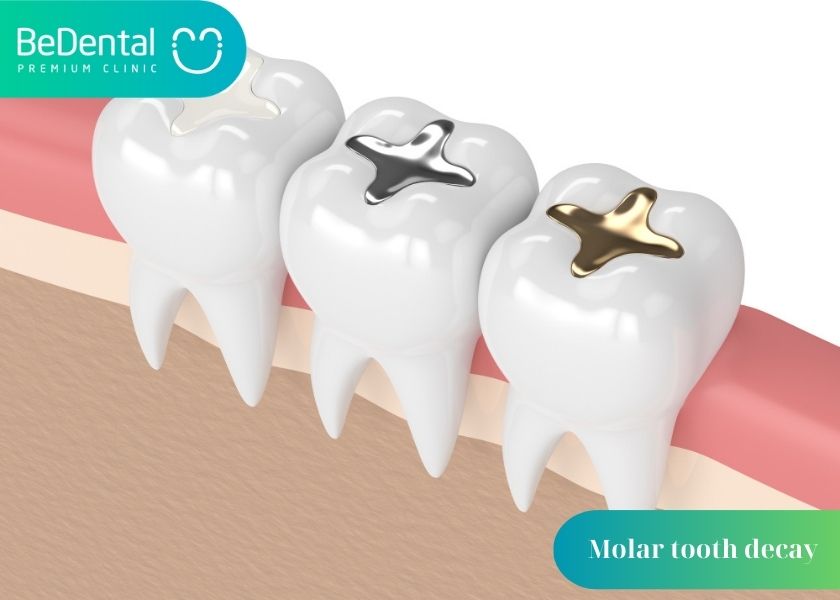 Can molars be extracted? Why is molar tooth decay so common? Methods of treating decayed molars.