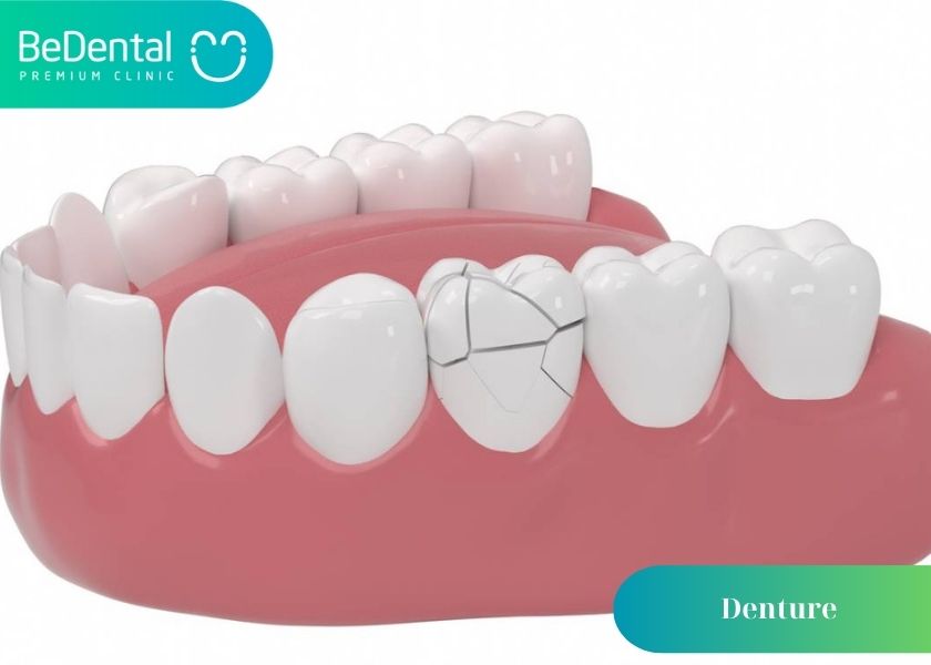 What are dentures? Causes of dentures fall out. Tips for taking care of dentures to avoid falling out