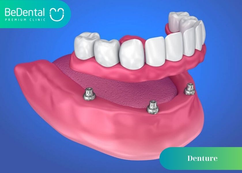 What are dentures? Causes of dentures fall out. Tips for taking care of dentures to avoid falling out