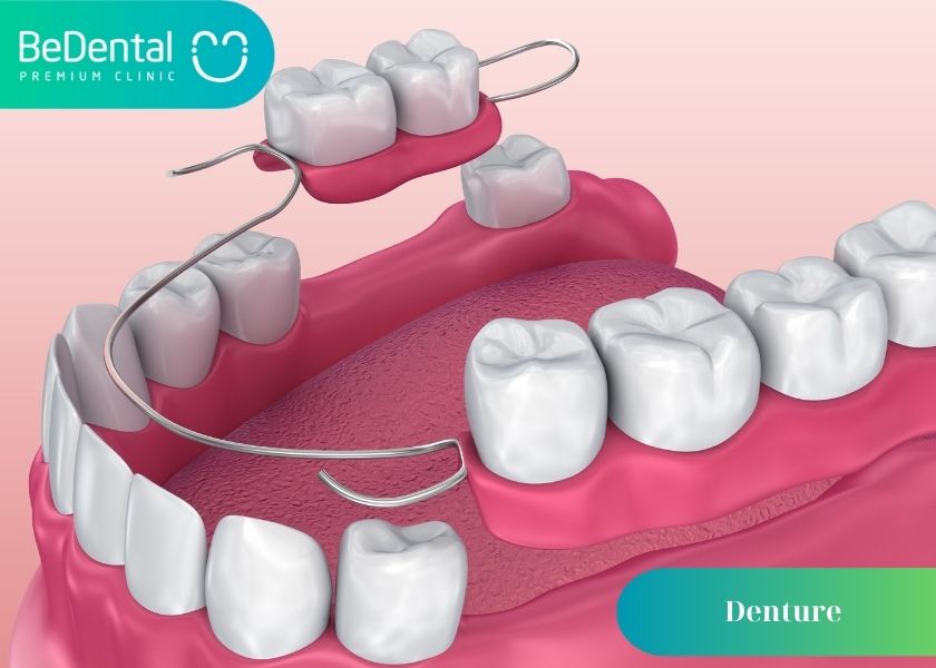 What are dentures? Causes of dentures fall out. Tips for taking care of dentures to avoid falling out