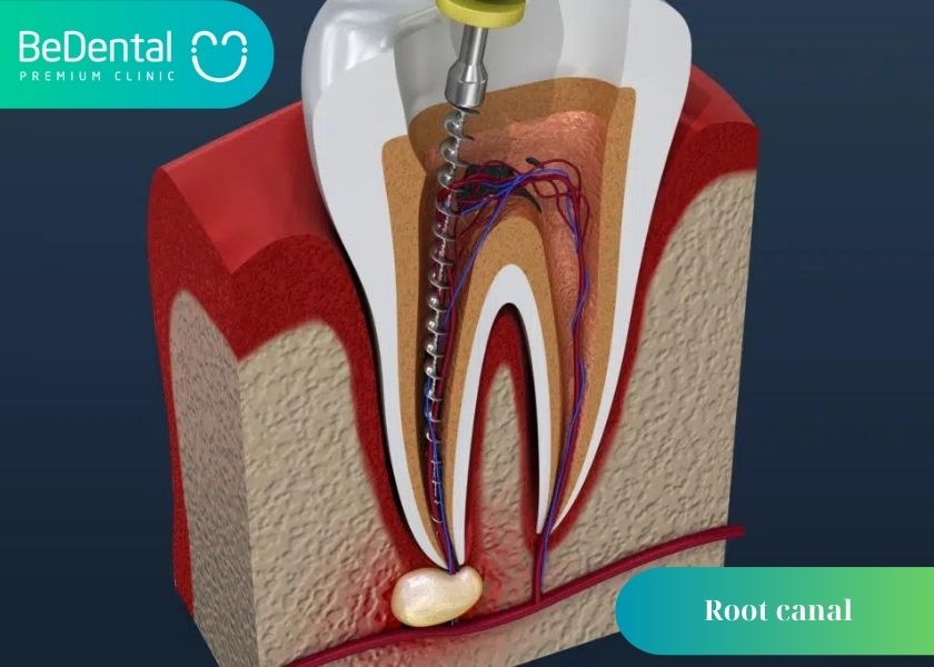 Why can root canals not be clean? What is the reason why the root canal is not clean? How much does a cavity filling cost?