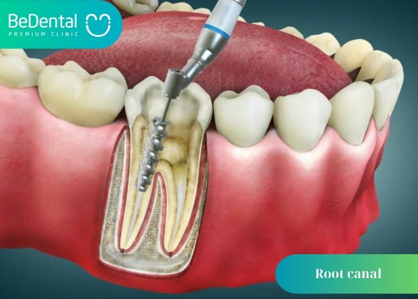 Why can root canals not be clean? What is the reason why the root canal is not clean? How much does a cavity filling cost?