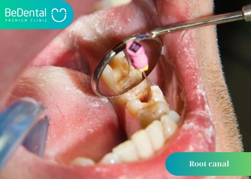 Why can root canals not be clean? What is the reason why the root canal is not clean? How much does a cavity filling cost?