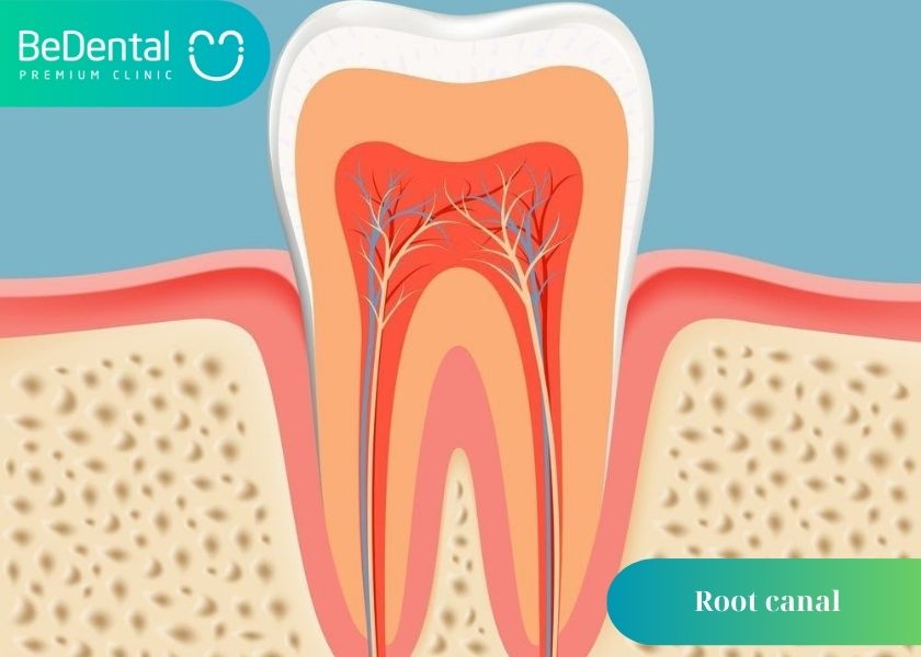 Why can root canals not be clean? What is the reason why the root canal is not clean? How much does a cavity filling cost?