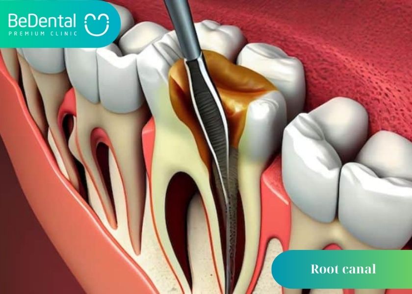 Why can root canals not be clean? What is the reason why the root canal is not clean? How much does a cavity filling cost?