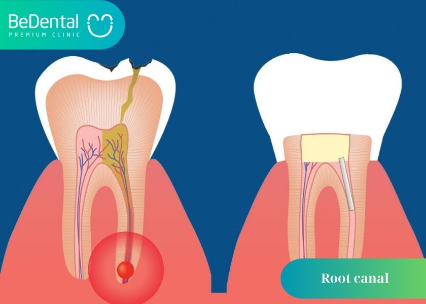 Why can root canals not be clean? What is the reason why the root canal is not clean? How much does a cavity filling cost?