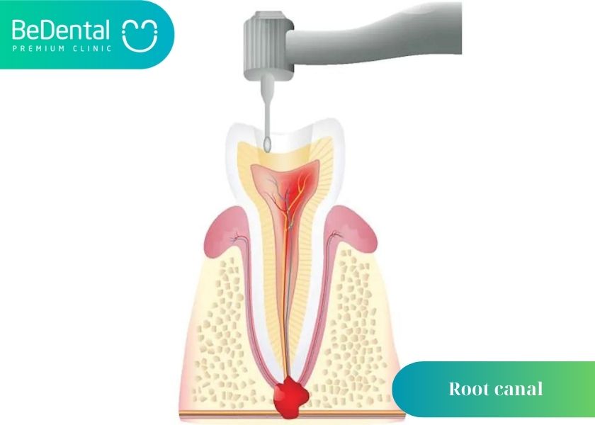 How do unclean root canals affect your health