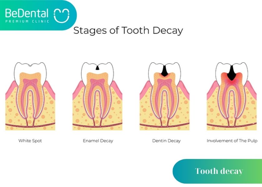 Is tooth decay on the inside or outside dangerous? How to effectively prevent side tooth decay? What causes lateral tooth decay?